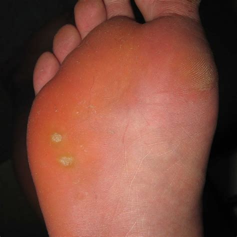 Plantar Wart Arch Of Foot at Ian Stewart blog