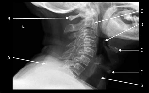 Lateral plain radiograph of the cervical spine | The BMJ