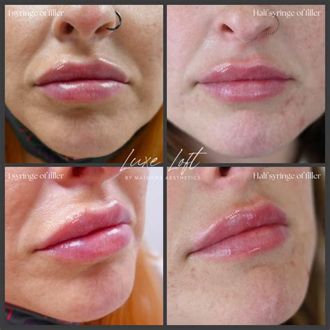 LIP FILLER GALLERY | See Stunning Transformations — Luxe Loft