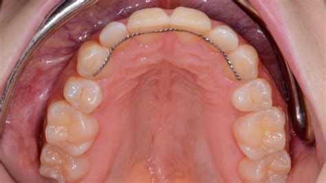 Retenedores Fijos: qué son, ventajas, desventajas y cuándo usarlos – ORTODONCIA BOGOTÁ
