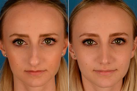 What To Wear For Rhinoplasty Surgery at George Buttenshaw blog