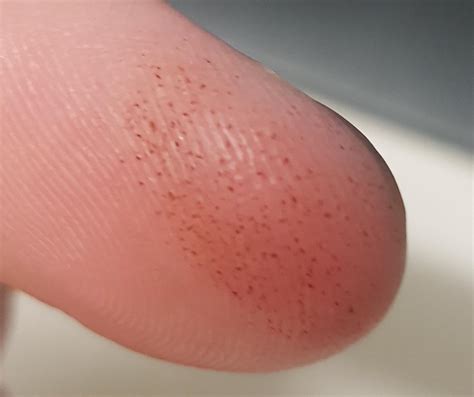 Smashed finger, strange black dots. : r/medical