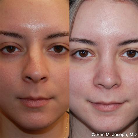 Eric M. Joseph, MD | Rhinoplasty Before & After: Corrected Nasal Flaring