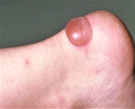 Blister on Foot - Causes and How To Treat Foot Blisters