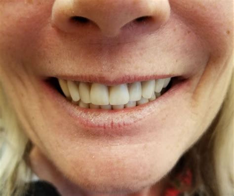 Smile Gallery | Central Valley Dentistry