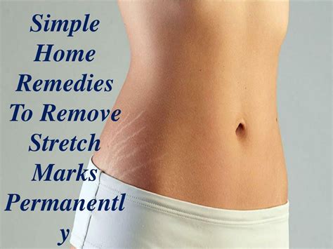 PPT - Simple Home Remedies To Remove Stretch Marks Permanently ...