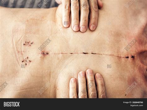 Scar Open Heart Image & Photo (Free Trial) | Bigstock