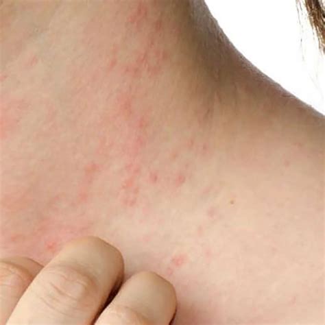 Dermatitis atópica: cómo es la enfermedad que “pica todo el tiempo” | Semanario Extra