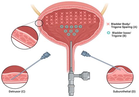 Intravesical Onabotulinum Toxin A Injection Paradigms for Idiopathic Overactive Bladder: A ...