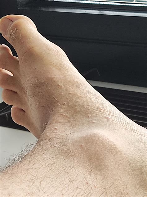 Itchy red bumps on hands and small bumps on feet : r/DiagnoseMe