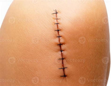 close-up of a surgical scar with dissolvable stitches healing on skin ...