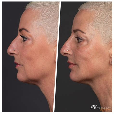 Treat Marionette Lines With Dermal Filler – M1 Med Beauty Australia
