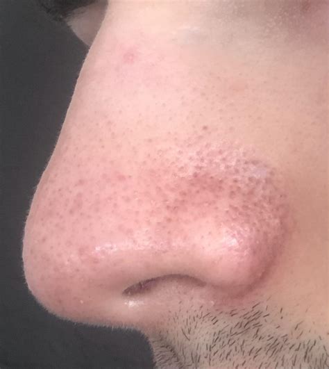 [routine help] sebaceous filaments/blackheads on my nose. I currently use 4% BHA, Azelaic acid ...