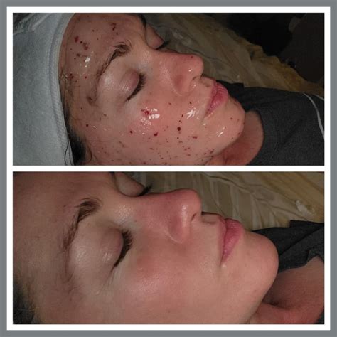 Jamie Lyn | **New Service Alert** Dermaplaning is a safe exfoliating ...