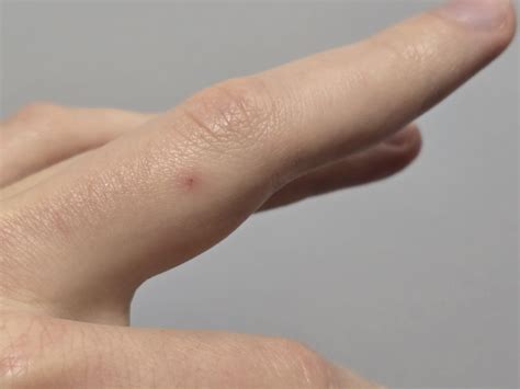 Red marks and bumps on palm and fingers - no pain, what could they be? : r/DermatologyQuestions