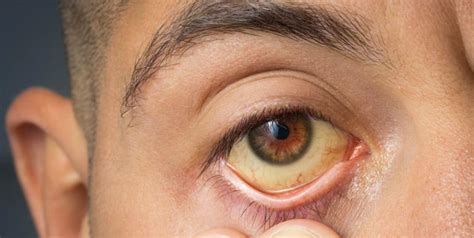 What Causes Yellow Eyes or Jaundice Eyes | OnlyMyHealth
