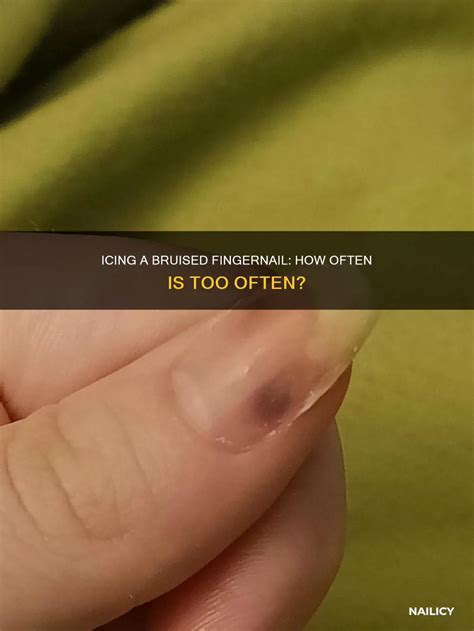Icing A Bruised Fingernail: How Often Is Too Often? | Nailicy
