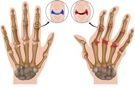 Early Osteoarthritis Hands