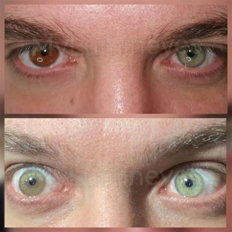 Heterochromia: Types, Causes & Medical Insights