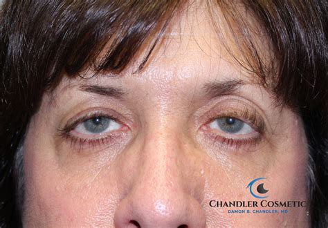 Ptosis Of Eyelid Philadelphia | Dr. Chandler