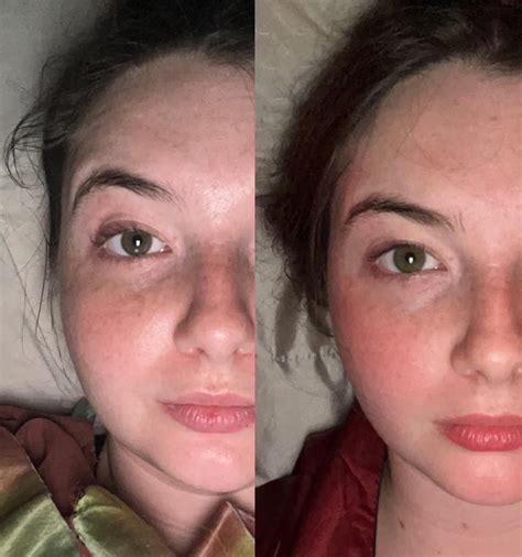 1 Day before vs 30 days After Nexplanon Removal : r/Nexplanon