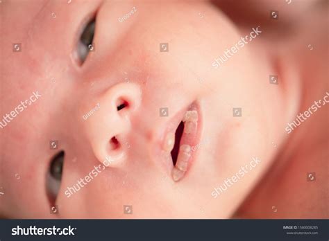 Dry Chapped Lips On Newborn