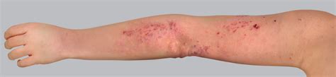 Comprender el eczema en los adultos | Fundación Eczema