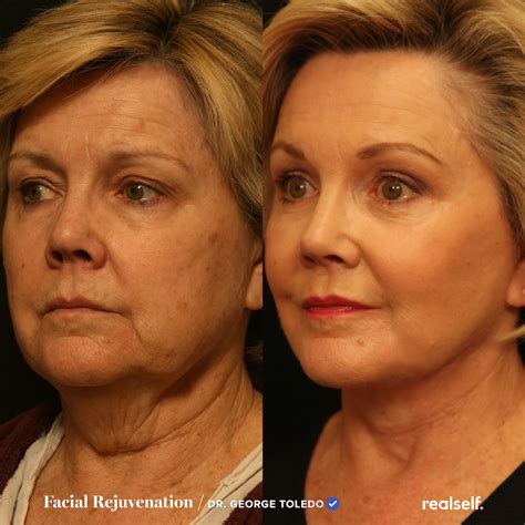 Facelift Surgery (Rhytidectomy): The Ultimate Guide | RealSelf | Face lift surgery, Sagging skin ...