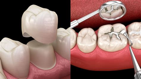 Dental Crown vs Filling: Which Is Best For You?