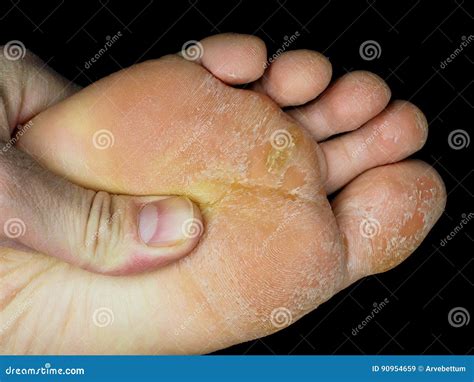 Toe Skin Peeling