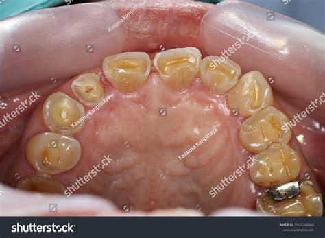 Attrition Teeth