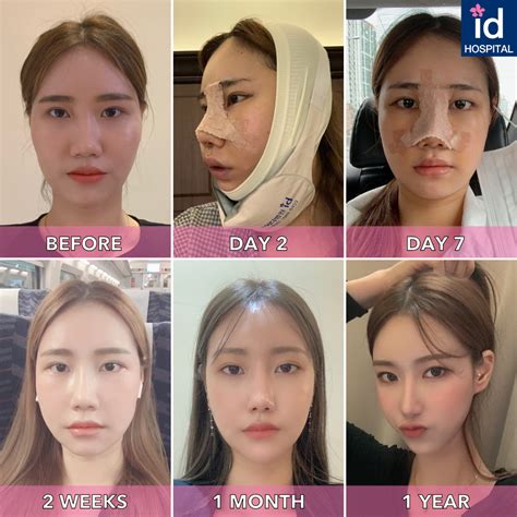 facial contouring and rhinoplasty before and after id hospital korea | Facial contouring, Korean ...