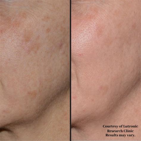 Hyperpigmentation Laser Treatment