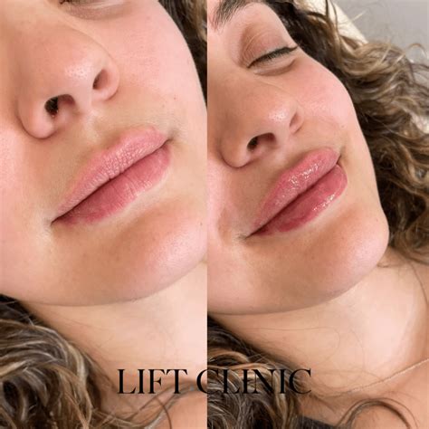 What Does 1ml of Lip Filler Look Like? 1ml Lip Fillers Before and After ...