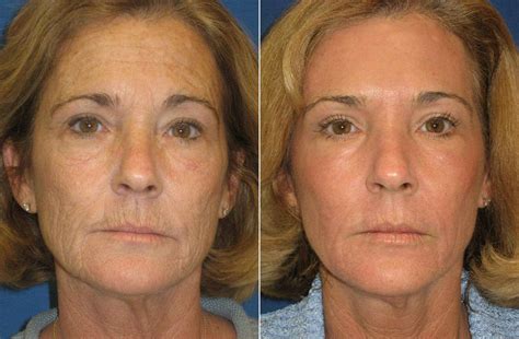 Co2 Laser Skin Rejuvenation — Ridgway Plastic Surgery & Medical Spa