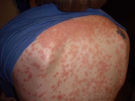 Psoriasis On Back