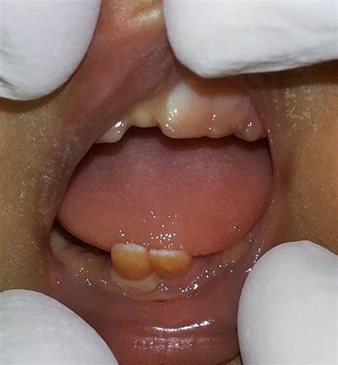 Natal teeth in premature dizygotic twin girls | BMJ Case Reports