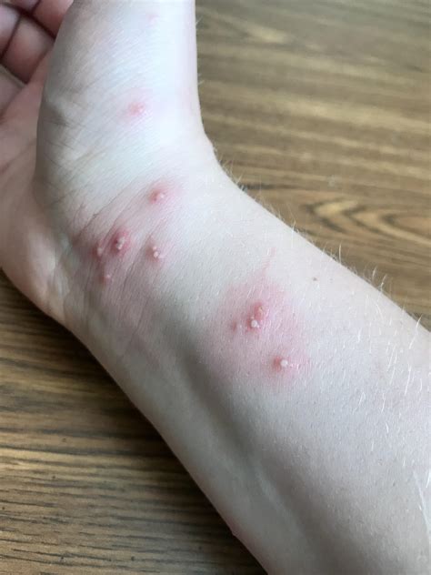 What Do Fire Ant Bites Look Like On Dogs