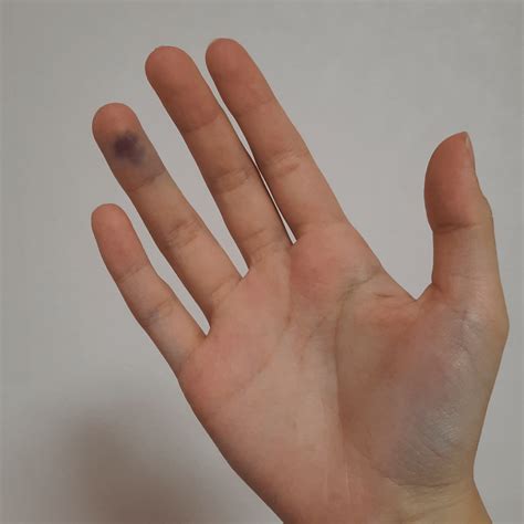 Finger prick site bruised and swollen : r/Blooddonors