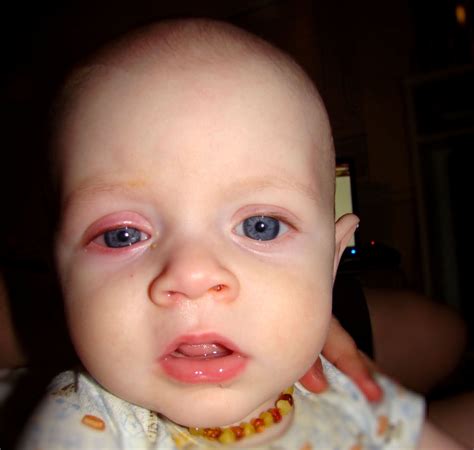 Causes and Treatment for Conjunctivitis in Babies | New Health Advisor