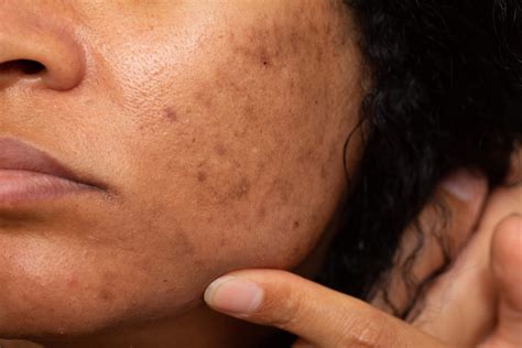 7 Dermatologist Tips to Remove Dark Spots on Face - Kosmoderma