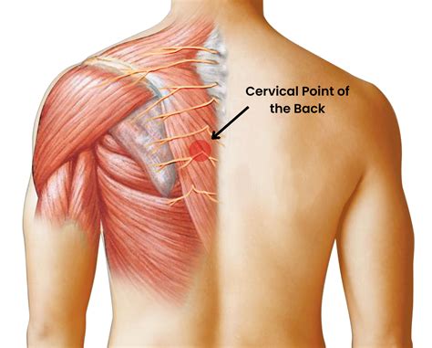 Dorsal Scapular Neuropathy is More Common Than Expected — ChiroUp