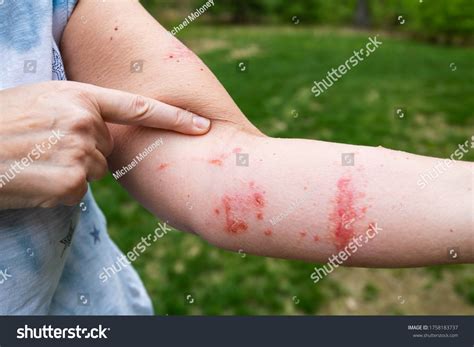 466 Poison ivy rash Images, Stock Photos & Vectors | Shutterstock