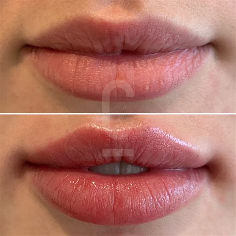 Russian Lips | Russian Injection Technique | Cosmetic Connection
