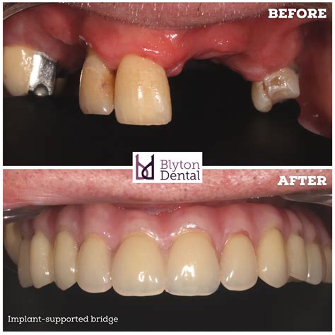 Implant-supported bridge — Blyton Dental