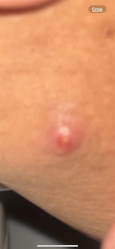 pimple popping community