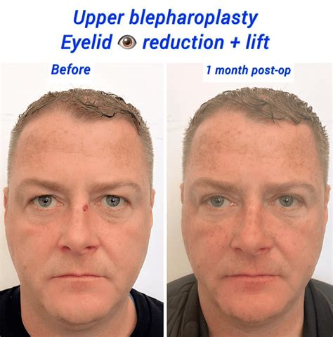 Almond Eye Surgery: Here’s What You Need to Know - Harley Clinic