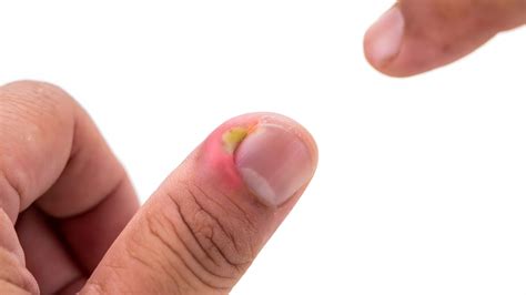 What Causes Hangnails and How to Treat Them | TheBeautyFoodie