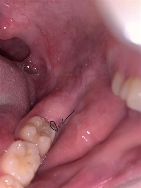 Wisdom teeth coming in? : r/medical