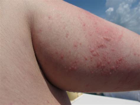 Moon Jellyfish Sting